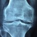 x-ray of an inflamed knee