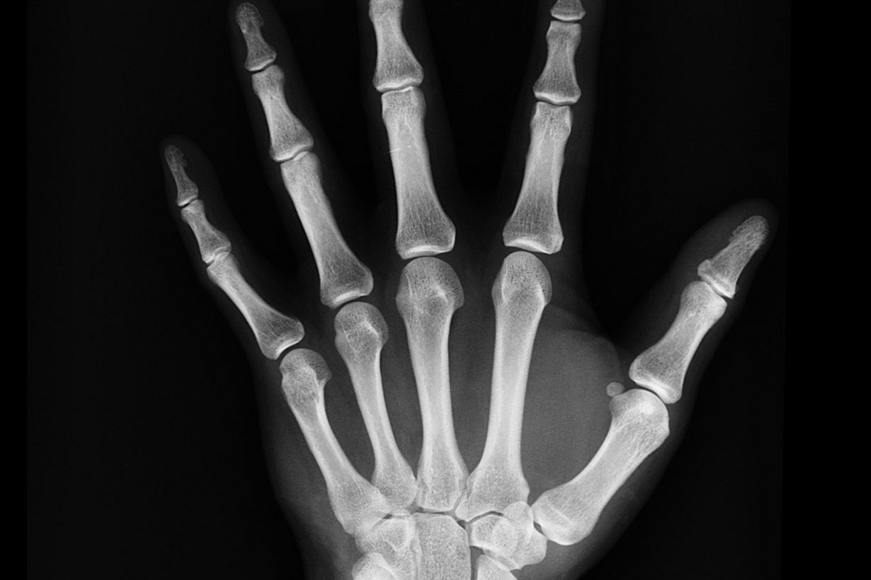 X-Ray of a person's hand