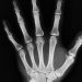 X-Ray of a person's hand