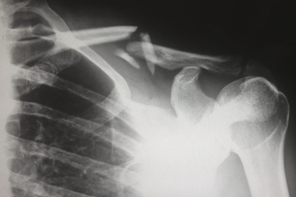 X-ray of a person's broken collar bone