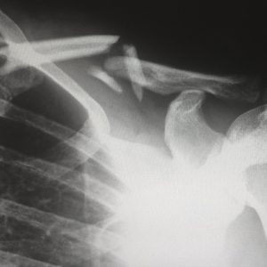 X-ray of a person's broken collar bone