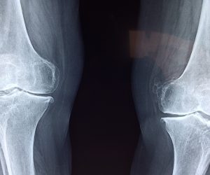 x-ray of two knees