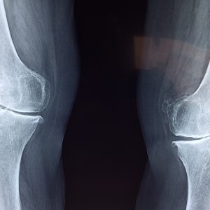 x-ray of two knees