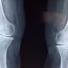 x-ray of two knees
