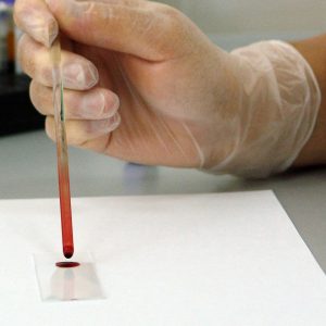 gloved hand putting blood on a microscope lens