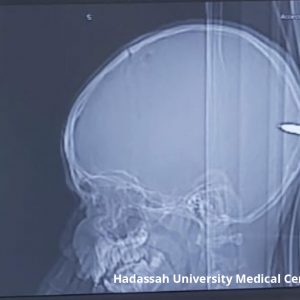 X-Ray of a boy's skull with a bullet in it